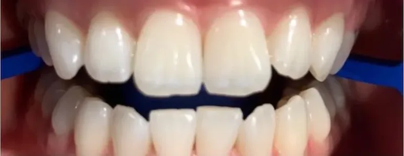 Dientes visiblemente más blancos después de una sesión de blanqueamiento